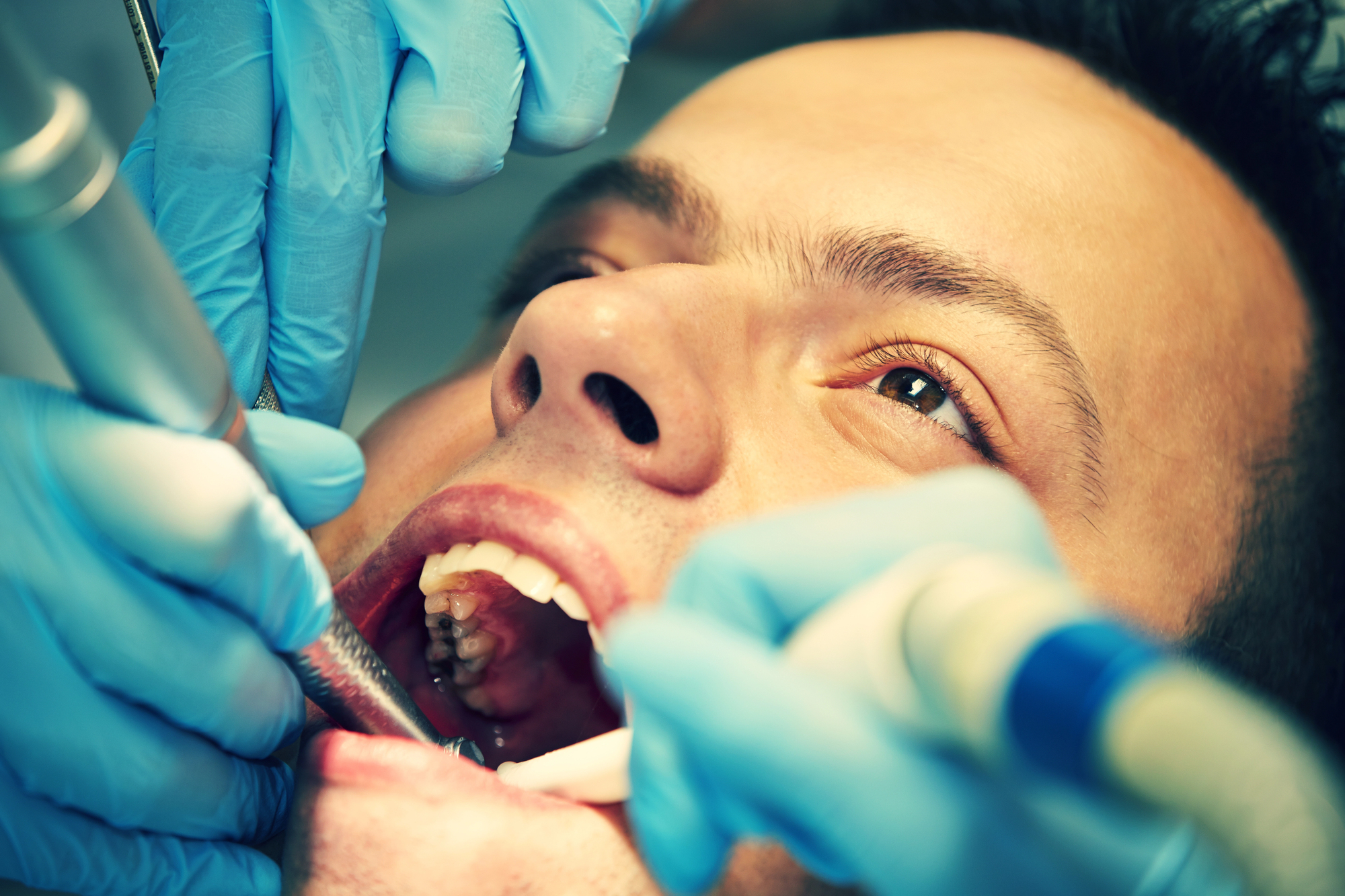 Composite Fillings