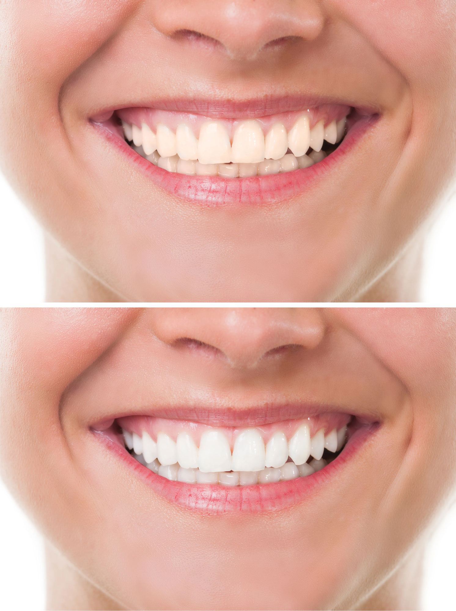 Before and after images of teeth whitening.